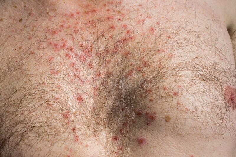 Chest Skin Rash As Drug Side Effect After Surgery Stock Photo Image