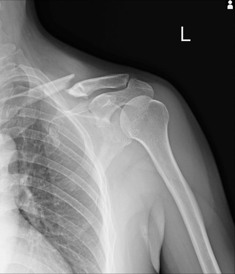 Chest x-ray Fractures left clavicle, anterior 2nd rib, posterior rib 4,5 and lateral aspect of left 6 th rib