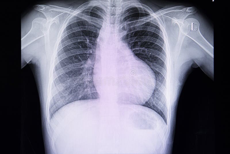 Chest xray film of a patient with right ventricular hypertrophy