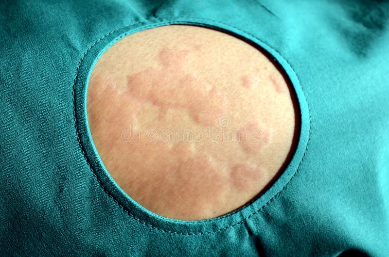 Chiazze cutanee, orticaria, reazione allergica della pelle immagine stock libera da diritti Chiazze cutanee, orticaria, reazione allergica della pelle immagine stock libera da diritti