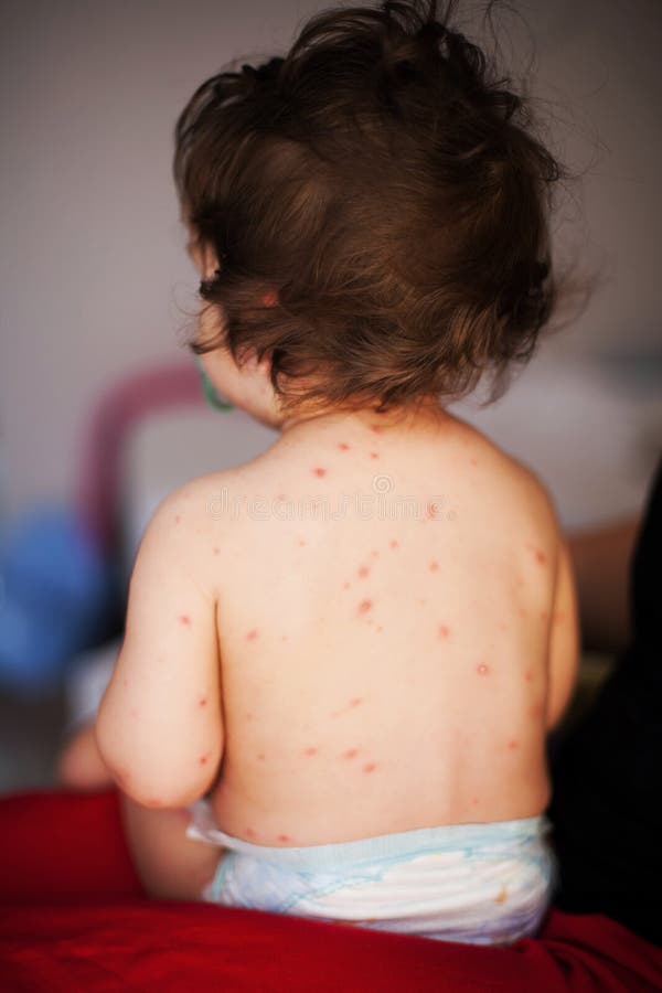 Treatment for chicken pox stock image. Image of nursing 39112793