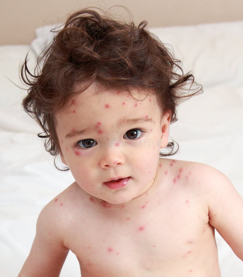 Bambino con contagiosa la varicella, eruzione cutanea.