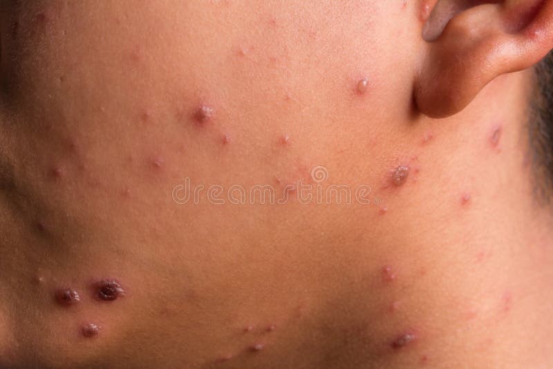 Chicken pox rash stock image. Image of ache, healing - 90697651