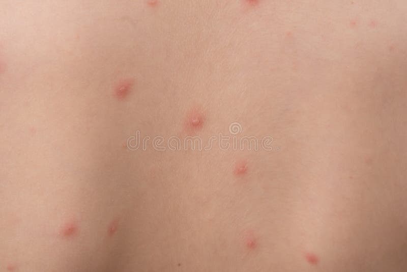 Chicken Pox Rash On Young Boy Body Chickenpox Is An Infection Caused By The Varicella Zoster Virus It Begins As A Blister Like Stock Image Image Of Infection Measles