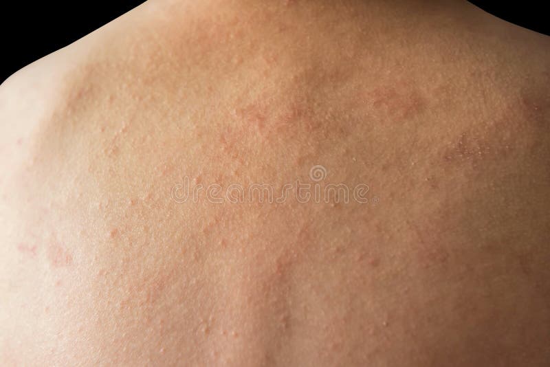 Eczema On Child Skin Stock Photo Image Of Illness Healthcare 15803284