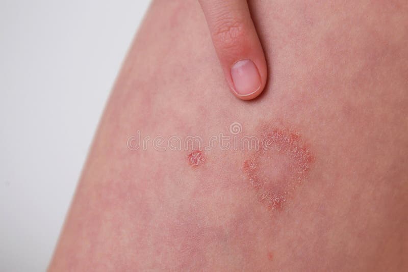 The Child Has Allergic Contact Dermatitis on the Skin Stock Photo