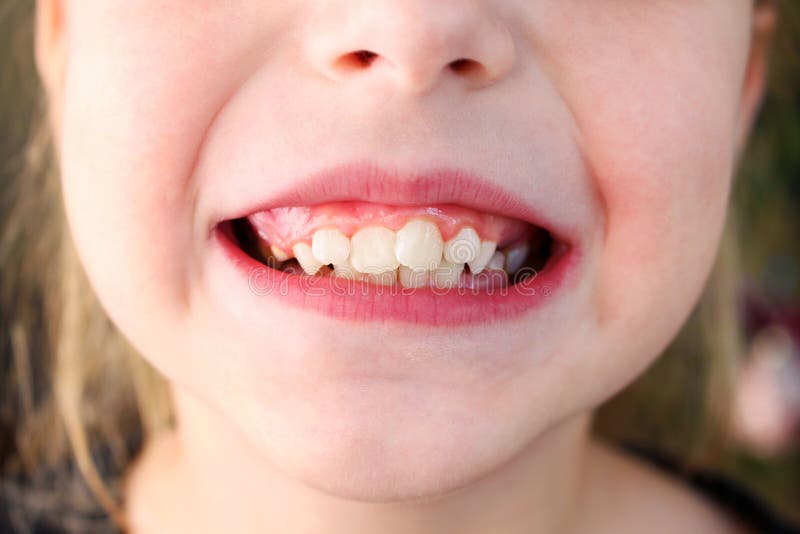 Child Has Crooked Teeth. the Concept of Crowding of Molars Stock Photo