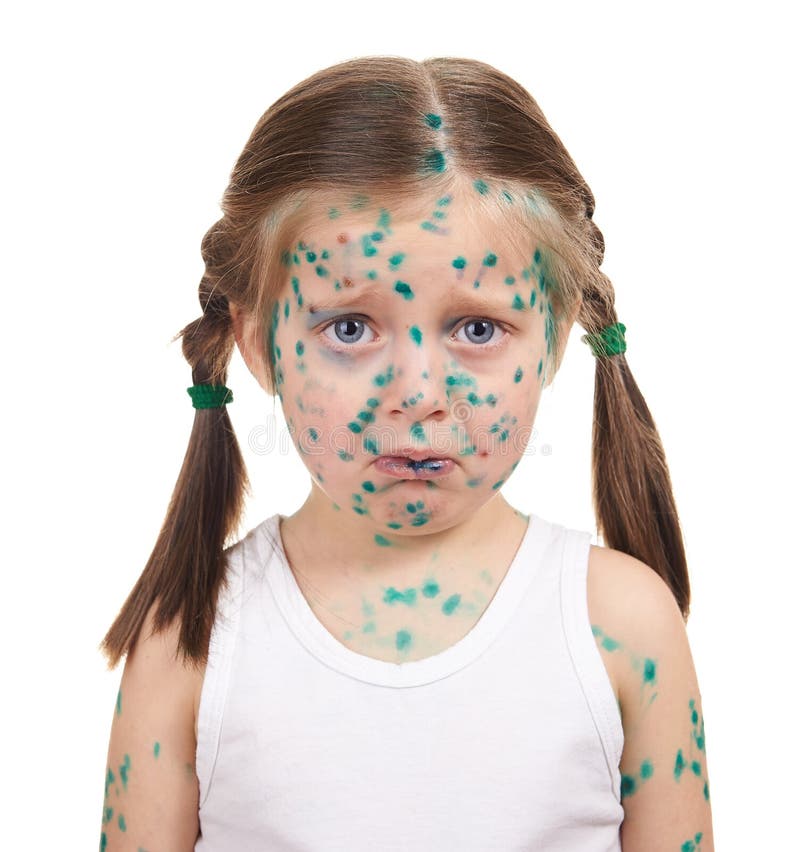 Child Has the Virus on Skin Stock Image Image of children, malady