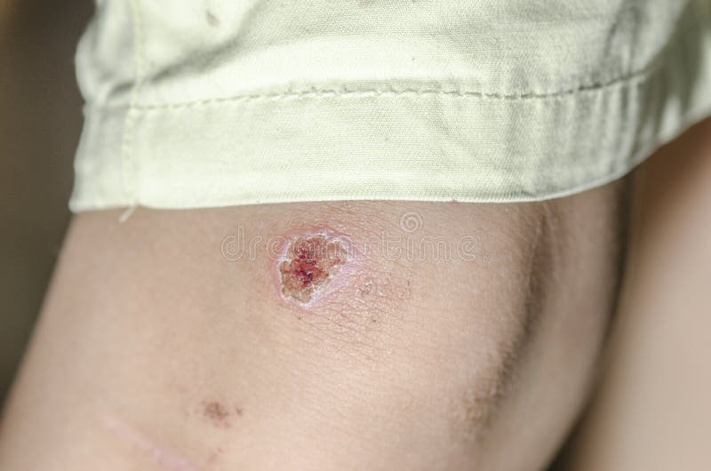 Child Hurt His Knee, An Abrasion On The Pavement Stock Image Image of