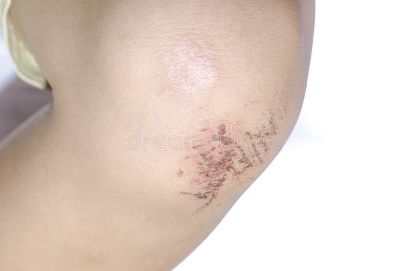 Child Hurt His Knee, an Abrasion on the Pavement Stock Photo Image of