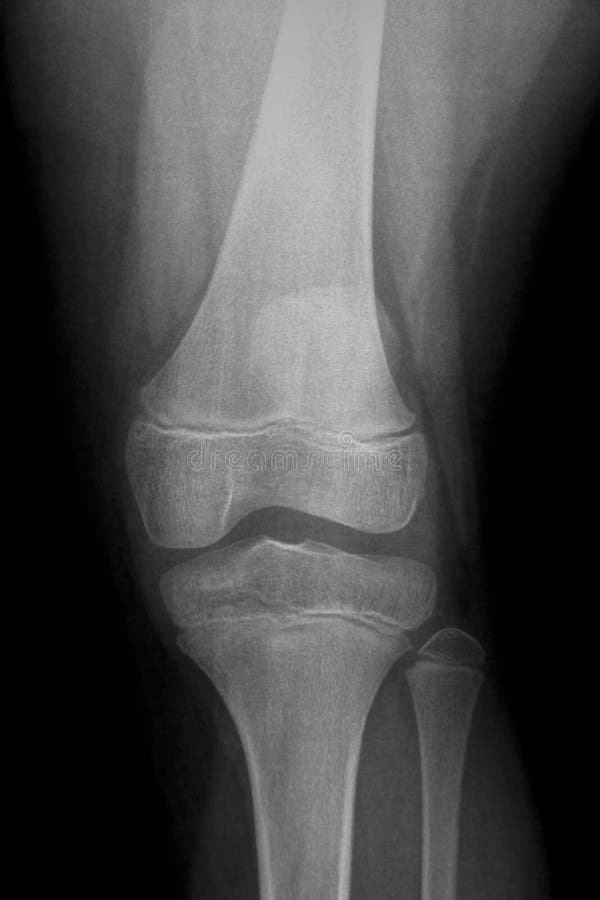 Child knee xray stock photo. Image of child, verticle 15528260