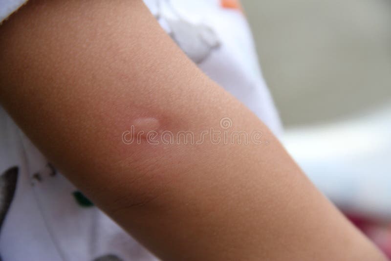 A Child& X27;s Hand Has a Sore from a Mosquito Bite. Stock Image Image of care, brown 243994325