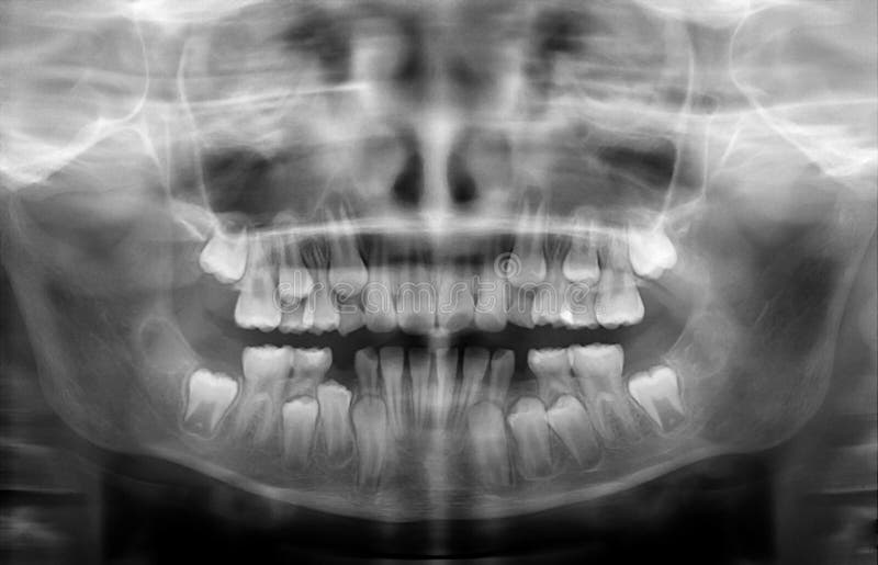 Child teeth Xray stock photo. Image of nine, dental 246681892