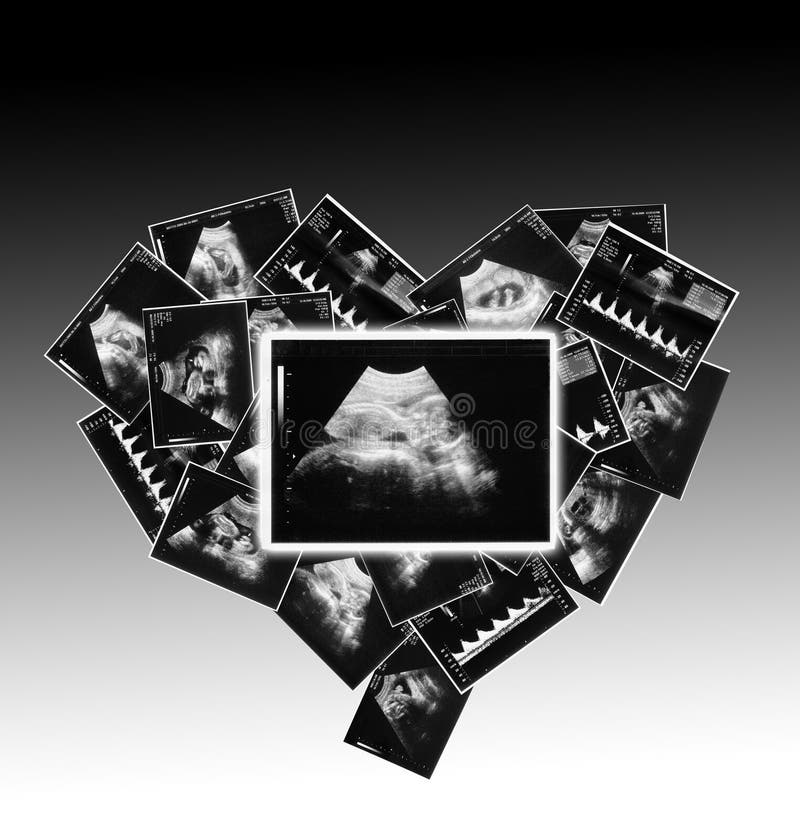 child on the ultrasound image