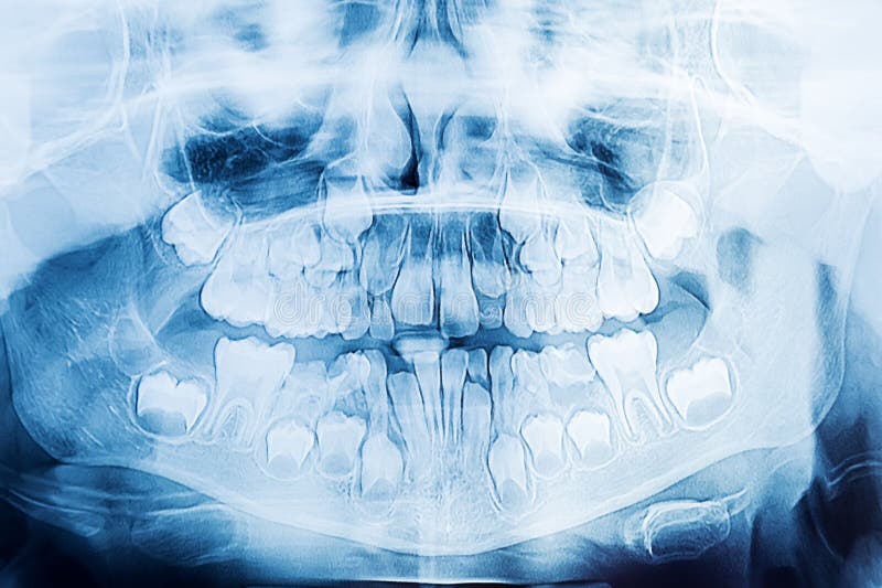 Children dental xray stock image. Image of mandible 88269551