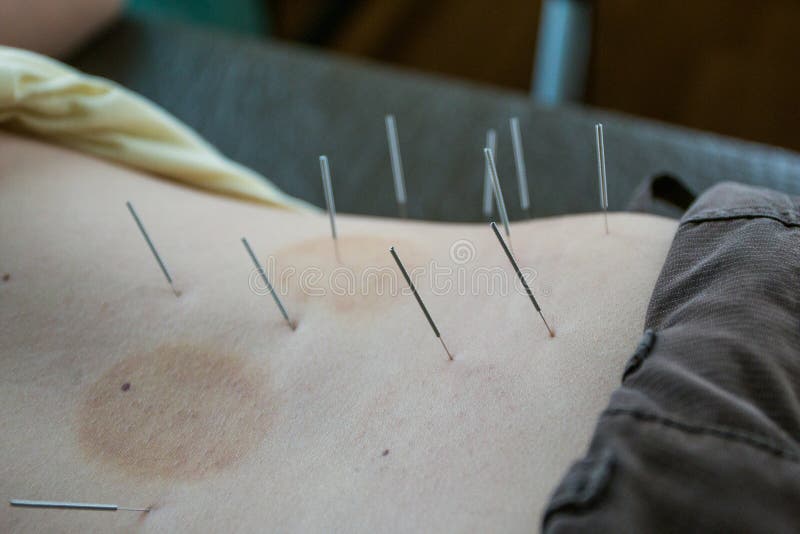 Chinese Acupuncture on Back for Treatment Stock Photo Image of health