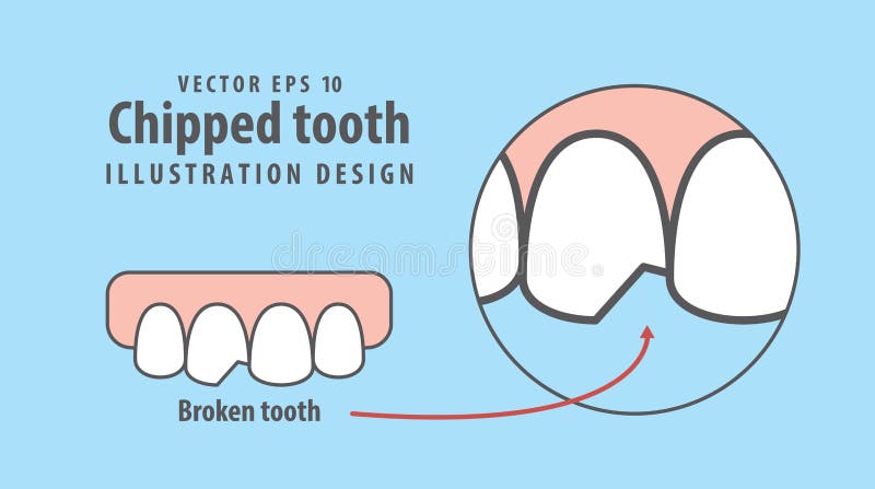 Chipped tooth illustration vector on blue background. Dental vector illustration