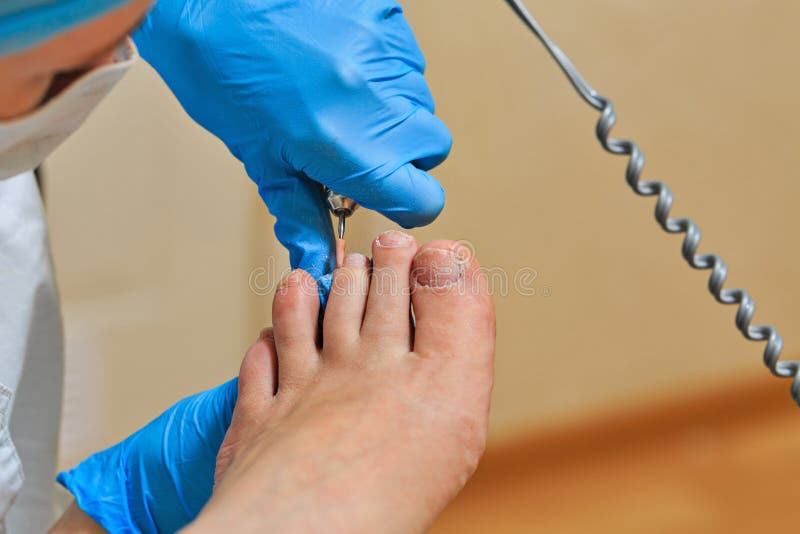 chiropody fotografia de stock royalty free chiropody fotografia de stock royalty free