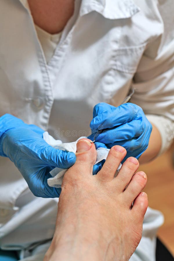 chiropody imagens de stock royalty free chiropody imagens de stock royalty free