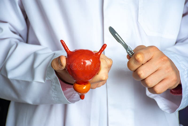 Chirurg hielt Skalpell über anatomischem Modell der menschlichen Blasenprostata, die es in ihrer Hand gegen Hintergrund des Körper lizenzfreie stockfotos