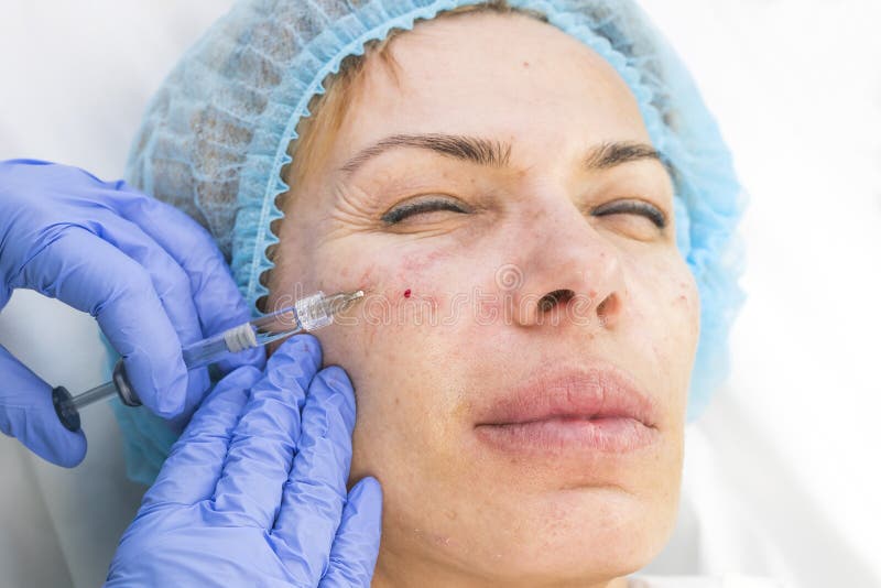 Chirurgie esthétique, procédure de médecine pour une femme adulte photographie stock Chirurgie esthétique, procédure de médecine pour une femme adulte photographie stock