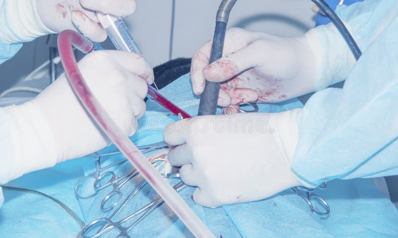 chirurgie Verwijdering van ruggegraatsingewandsbreuk stock afbeelding chirurgie Verwijdering van ruggegraatsingewandsbreuk stock afbeelding