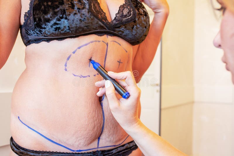 Chirurgien préparant la femme pour la chirurgie de liposuccion image stock Chirurgien préparant la femme pour la chirurgie de liposuccion image stock