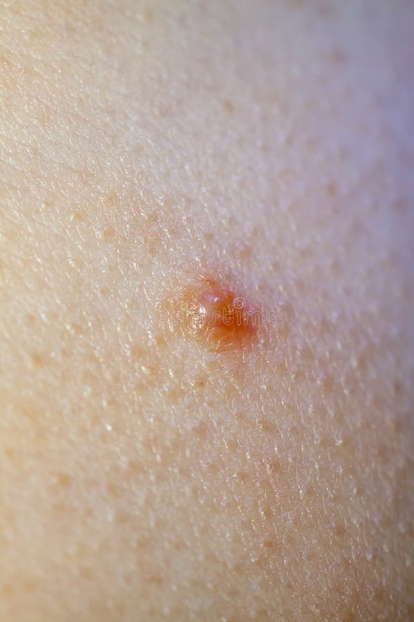 cura mollusco contagioso