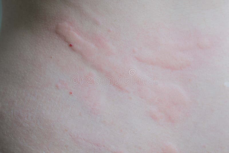 Chiuda su di orticaria fotografia stock Chiuda su di orticaria fotografia stock