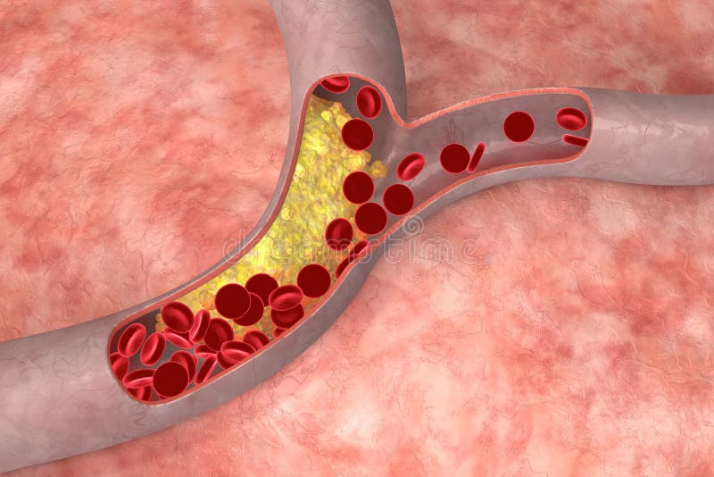 Cholesterol in artery stock illustration. Illustration of microbiology
