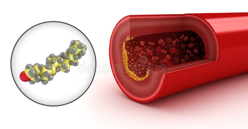 Cholesterol plaque in artery and cholesterol vector illustration