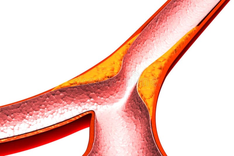 Cholesterol Plaque in Artery Stock Illustration Illustration of