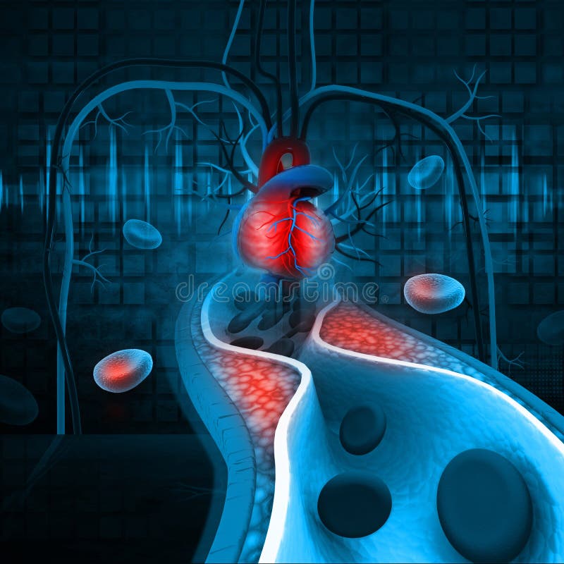 Cholesterol Plaque in Artery Stock Illustration Illustration of human