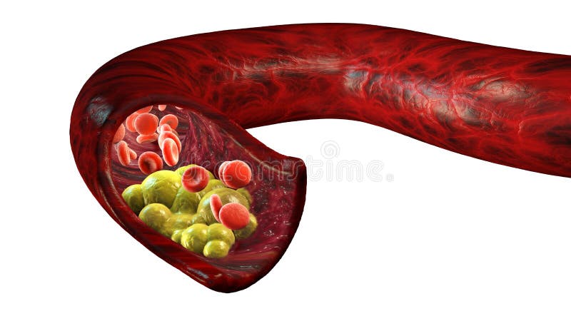 Cholesterolvorming, vet, slagader, ader, hart Rode bloedcellen, bloedstroom Het versmallen van een ader voor vette vorming vector illustratie Cholesterolvorming, vet, slagader, ader, hart Rode bloedcellen, bloedstroom Het versmallen van een ader voor vette vorming vector illustratie
