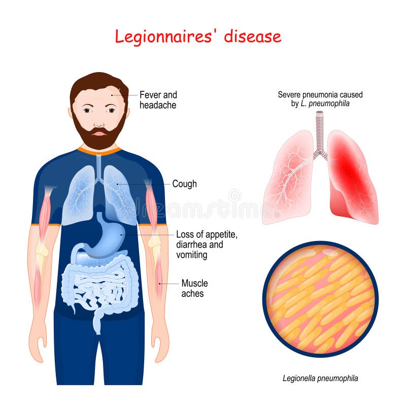 Choroba Legionistów Atypowe Zapalenie Płuc Wywołane Przez Bakterie Legionella Ilustracja Wektor