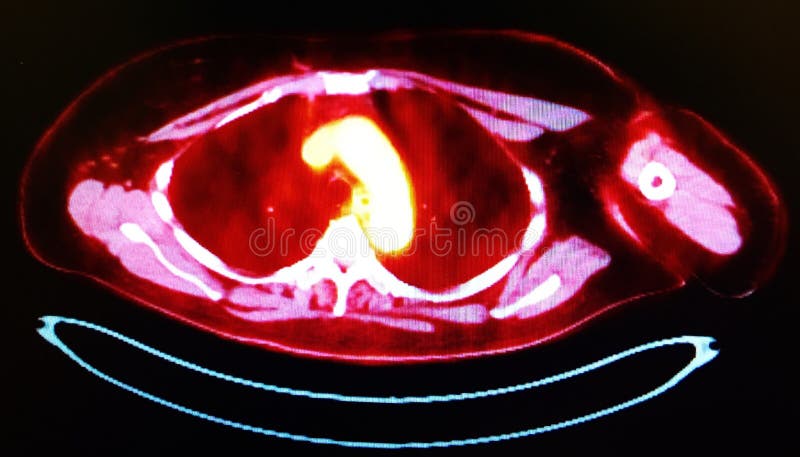 There is pulmonary neoplasm ,which diagnosed by PET/CT scan examination , proof of this pathology more effective for doctors on positron emission tomography images, which is field of nuclear medicine in radiology. There is pulmonary neoplasm ,which diagnosed by PET/CT scan examination , proof of this pathology more effective for doctors on positron emission tomography images, which is field of nuclear medicine in radiology.