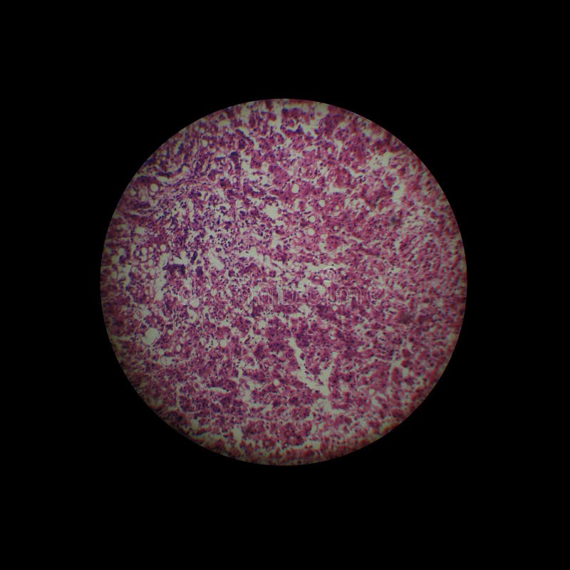 Chronische Hepatitis lizenzfreie stockbilder