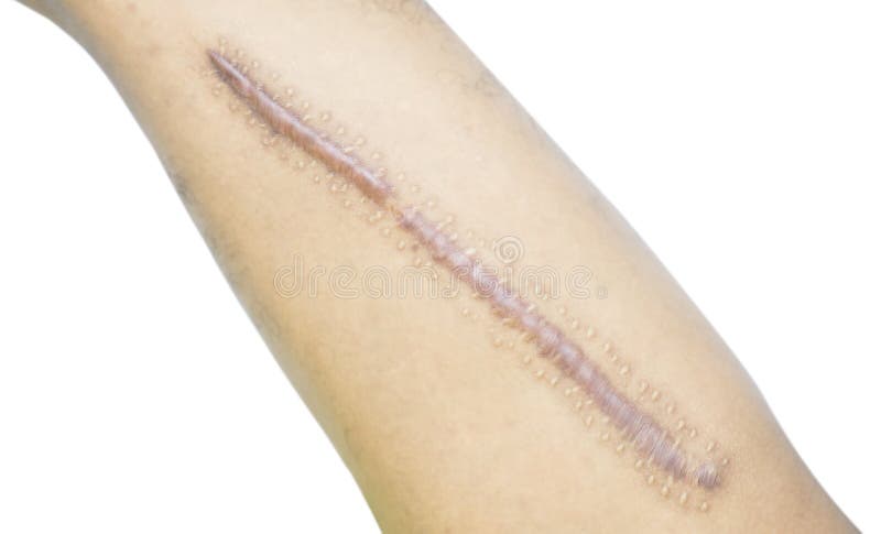 Cicatrice de keloid de plan rapproché sur la peau asiatique d'homme après la fracture de fémur, cuisse cassée sur le fond blanc images libres de droits Cicatrice de keloid de plan rapproché sur la peau asiatique d'homme après la fracture de fémur, cuisse cassée sur le fond blanc images libres de droits