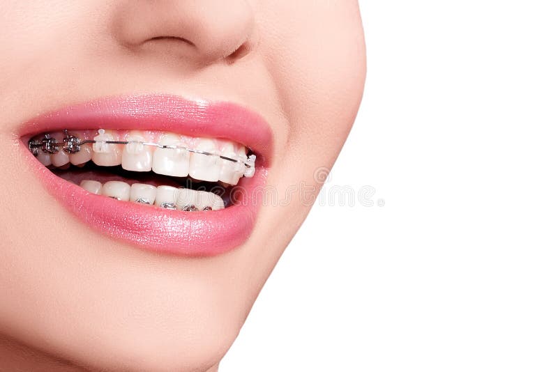 Cintas nos dentes Sorriso dental das cintas Tratamento ortodôntico