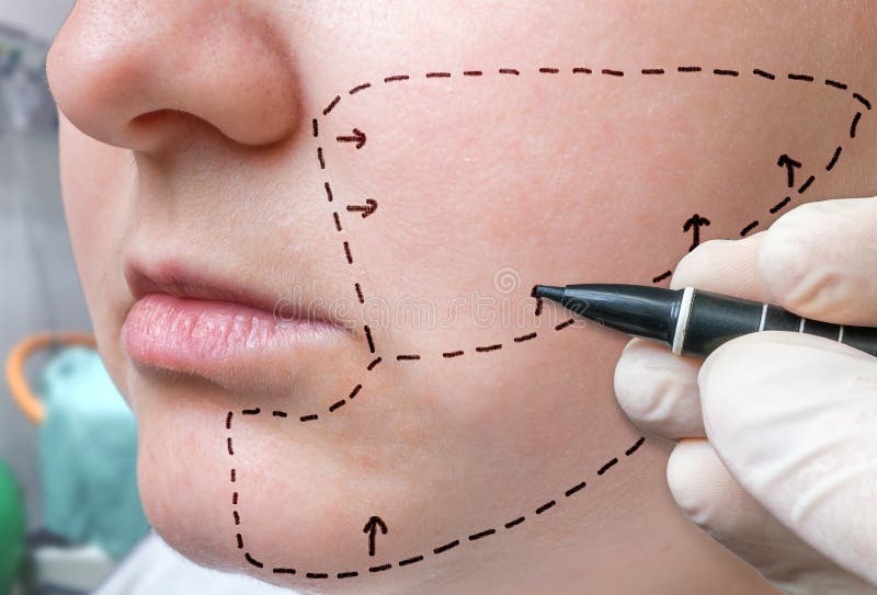 Cirugía plástica facial La mano está dibujando líneas con el marcador en mejilla imagenes de archivo Cirugía plástica facial La mano está dibujando líneas con el marcador en mejilla imagenes de archivo