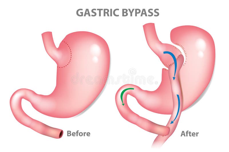 Ferramentas da cirurgia ilustração do vetor. Ilustração de vetor - 8678488