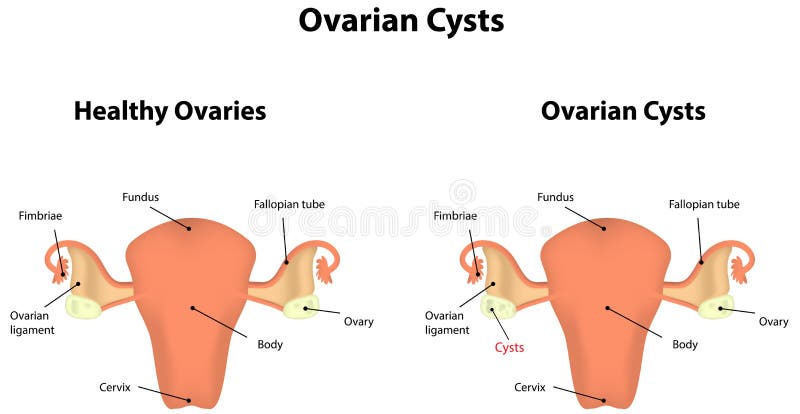 Ciste Mucinous Sull ovaia Cystadenoma Ovaia Illustrazione Vettoriale ciste-mucinous-sull-ovaia-cystadenoma-ovaia-illustrazione-vettoriale