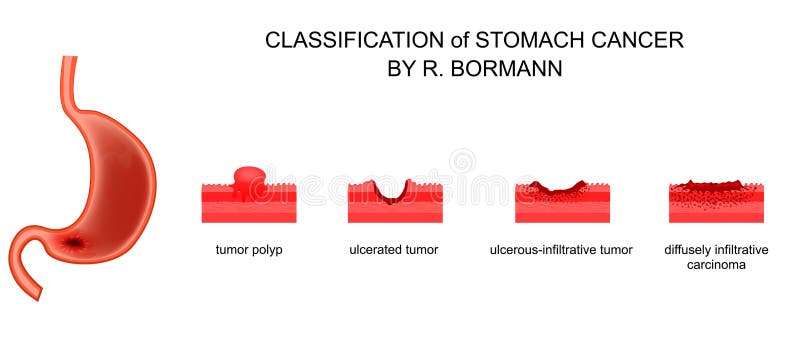 Gastric cancer bormann. Cancerul Gastric