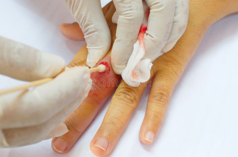 Leg abscess wound. stock image. Image of infection, health 63785803