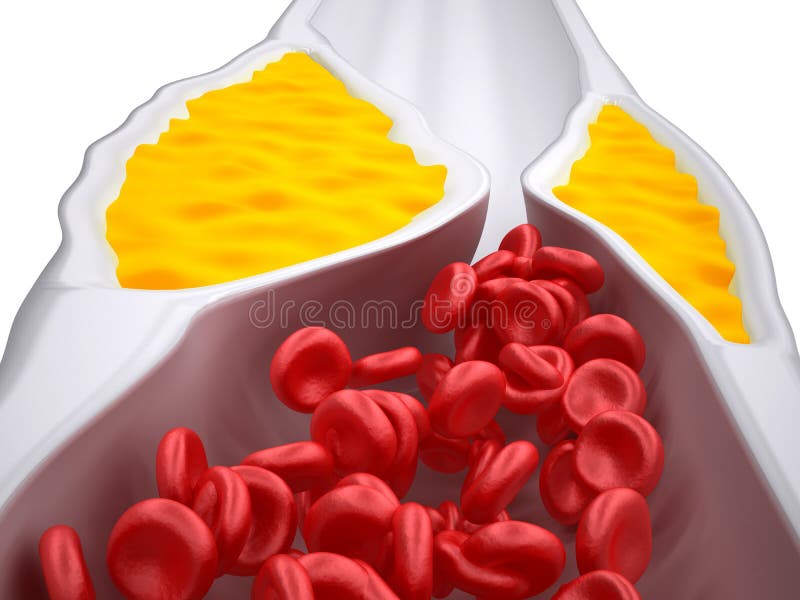 Clogged Artery - Atherosclerosis / Arteriosclerosis - Cholesterol plaque - detailed view stock illustration Clogged Artery - Atherosclerosis / Arteriosclerosis - Cholesterol plaque - detailed view stock illustration