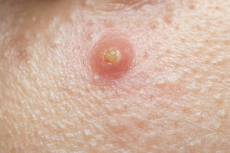 Close Up Acne , Acne Holes Welded on Face Stock Photo Image of