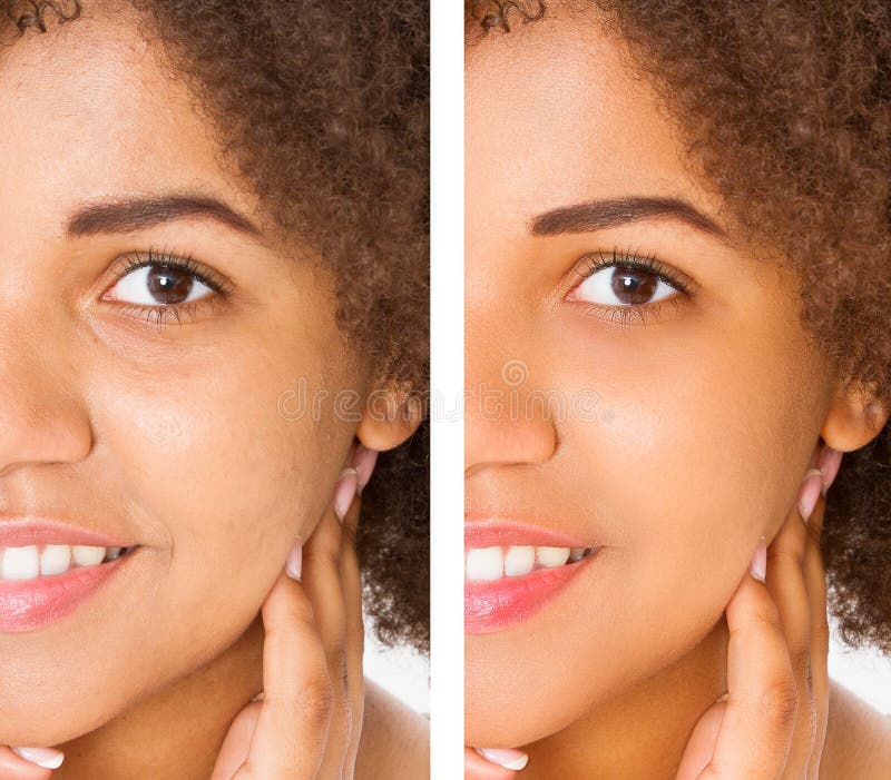 Before after close up african american woman face with acne and problem skin. Beauty skin care treatment. Before-after Facial stock photo Before after close up african american woman face with acne and problem skin. Beauty skin care treatment. Before-after Facial stock photo