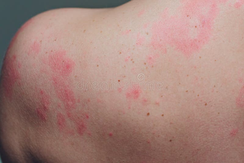 Close Up Allergy Rash Around Back View Of Human With Dermatitis