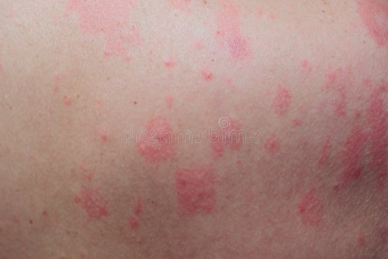 Close Up Allergy Rash Around Back View Of Human With Dermatitis