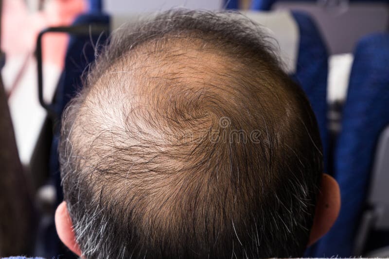 Close-up of Balding and Thinning Hair of Man Revealing Scalp Stock Image -  Image of human, people: 109394851